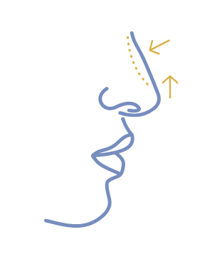 Nose Reshaping